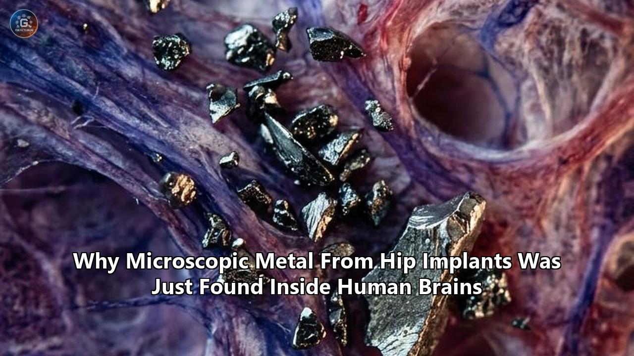 Why Microscopic Metal From Hip Implants Was Just Found Inside Human Brains