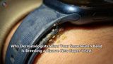 Why Dermatologists Warn Your Smartwatch Band Is Breeding a Bizarre New Super-Yeast