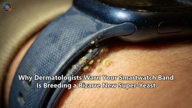 Why Dermatologists Warn Your Smartwatch Band Is Breeding a Bizarre New Super-Yeast